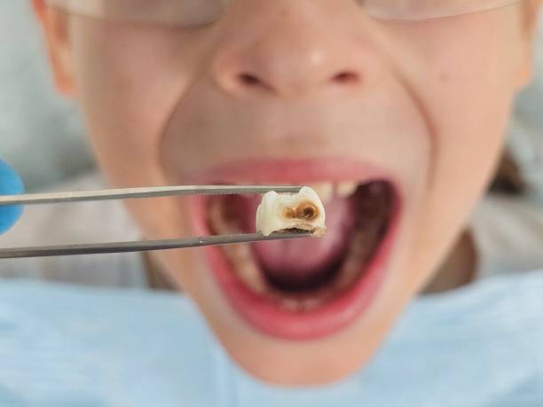 Best Emergency Dentist for Knocked-Out Tooth in Lynnwood, WA